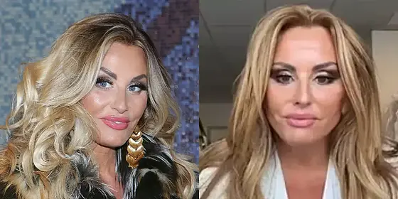 Dagmara Kaźmierska po liftingu twarzy
